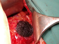 Zastosowanie technologii water i koagulacji plazmą argonową w chirurgii organooszczędzającej guza nerki – opis przypadku