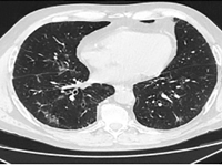 Infekcja SARS-CoV-2 u chorego na raka gruczołowego z mutacją w genie EGFR leczonego erlotynibem – opis przypadku